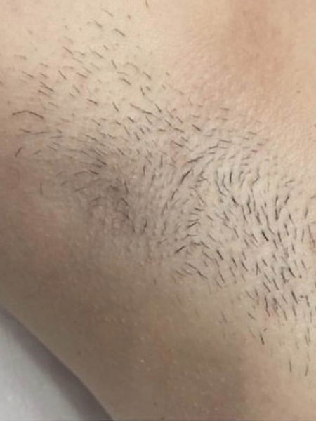 Grande plano de uma axila com pelos a crescer e barba curta