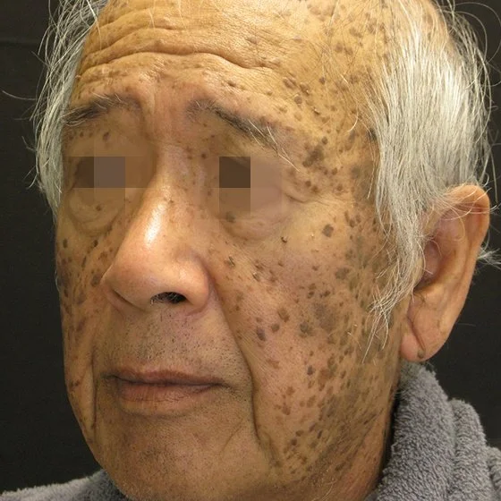 Homem idoso com manchas de pigmentação no rosto