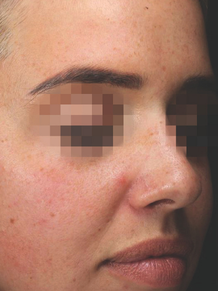 Grande plano do rosto de uma pessoa com os olhos desfocados, mostrando a textura e a cor da pele.