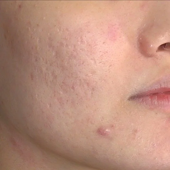 Grande plano da face e do queixo de uma pessoa com cicatrizes de acne e uma borbulha