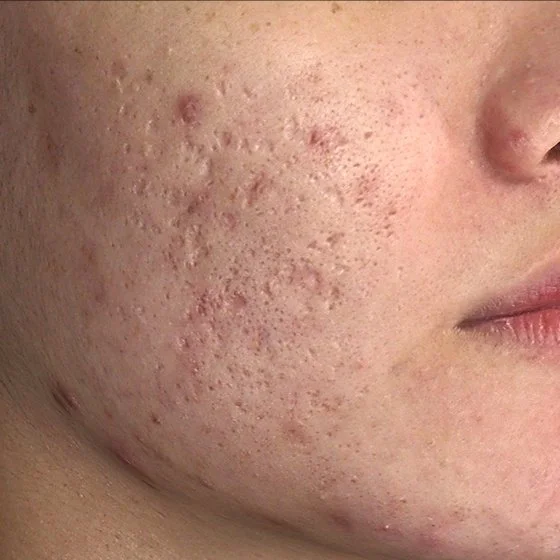 Grande plano do rosto de uma pessoa com cicatrizes de acne e imperfeições na face.