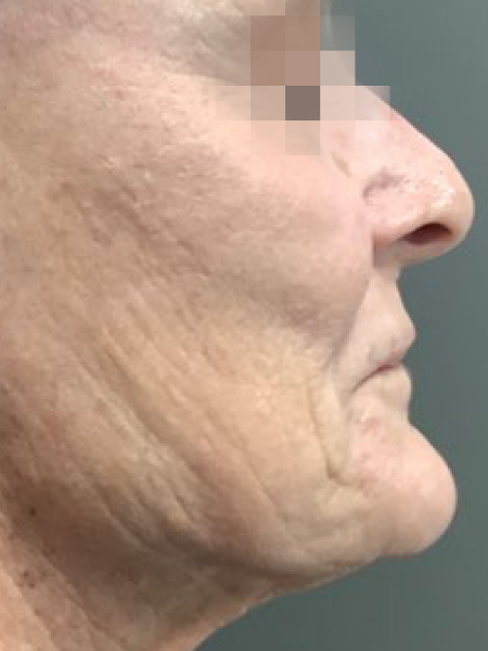 Perfil lateral do rosto de uma pessoa mais velha, mostrando a textura da pele e linhas de expressão