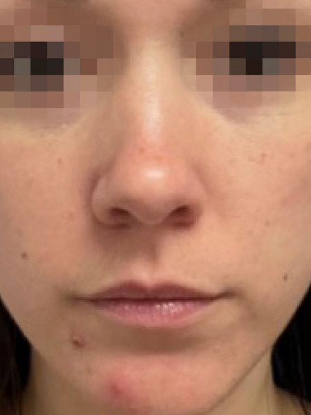 Grande plano do rosto de uma pessoa com os olhos desfocados, mostrando a textura da pele e acne ligeira.