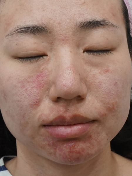 Pessoa de olhos fechados com acne e vermelhidão nas bochechas, no nariz e no queixo.