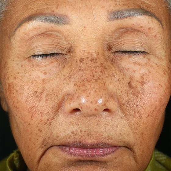 Grande plano do rosto de uma pessoa de olhos fechados, com sardas visíveis na pele.