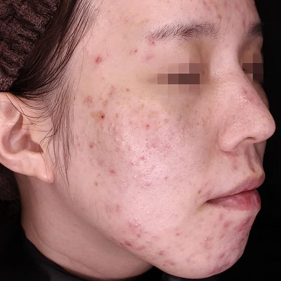 Imagem de perfil de uma pessoa com acne e cicatrizes na face.